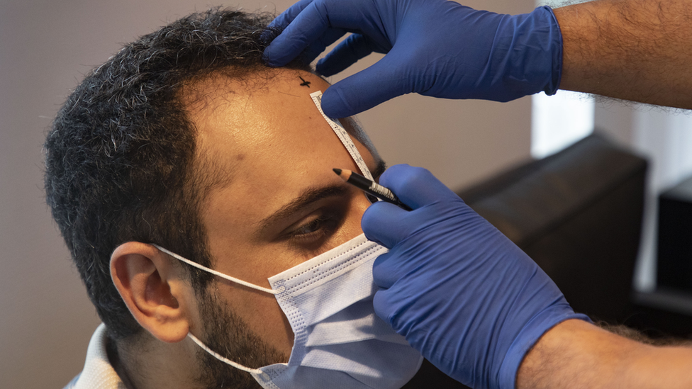 A patient prepares for hair transplant surgery in a Turkish clinic