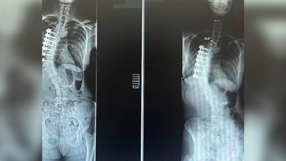 Two x-rays of Ms Ellis' spine