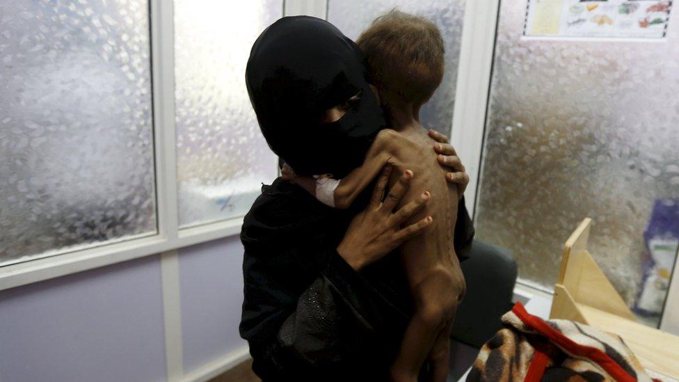 The mother of 21-month-old Majed Ayyash prepares him to be weighed at a malnutrition intensive care unit in Sanaa, Yemen (30 July 2015)