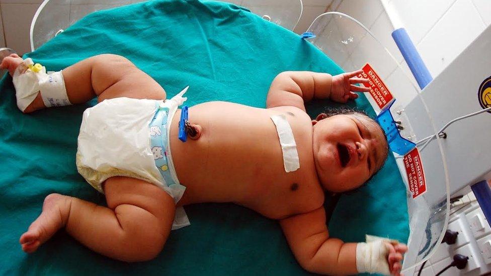 India's 'heaviest baby girl'