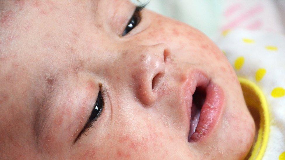 baby with measles