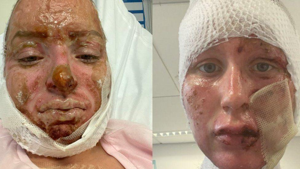 Two photos of Ashleigh and April sit side by side showing their faces wrapped in bandages apart