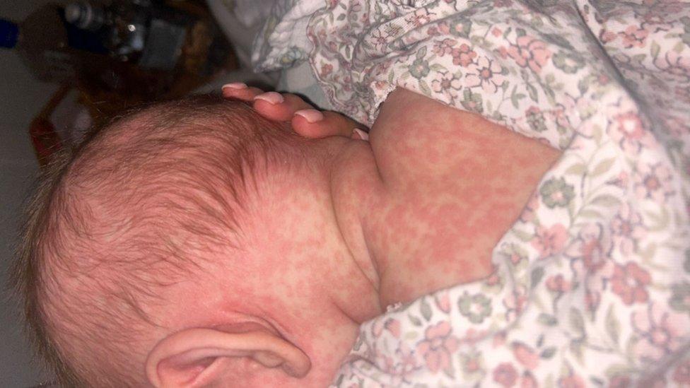 Image showing a measles rash on baby Margot's back