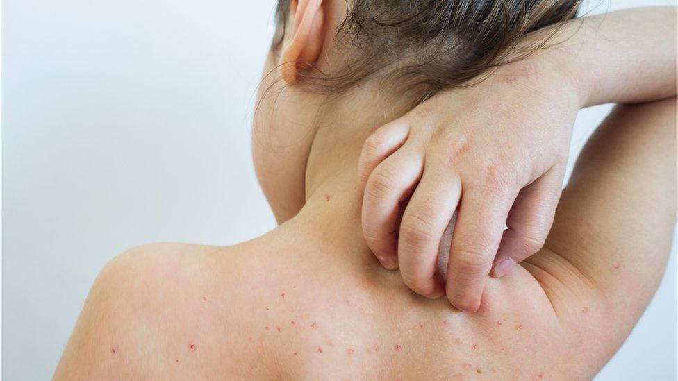 Child with chickenpox