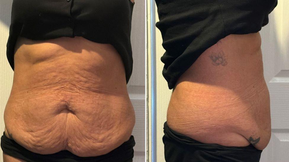 Two images of a stomach showing loose skin, one photo from the front and one from the side