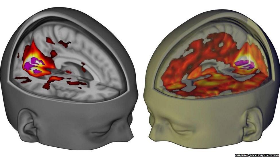 Brain scans