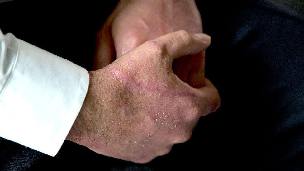 Slash wound on the hand of Inspector Moloy Campbell. Stitch marks can be seen on the top of his hand below the thumb when the injury was sustained