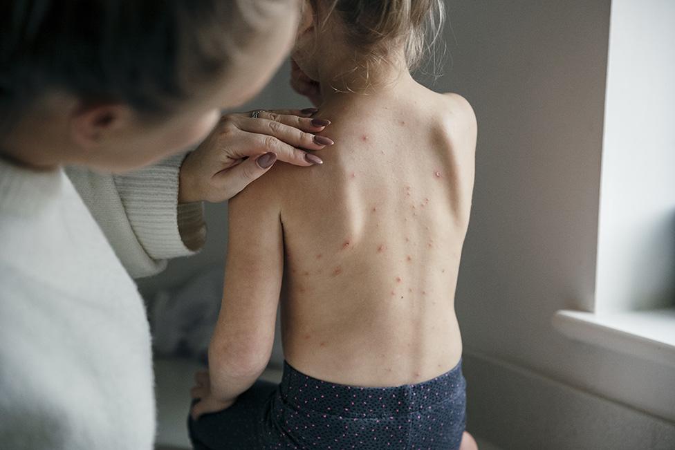 Girl with chickenpox