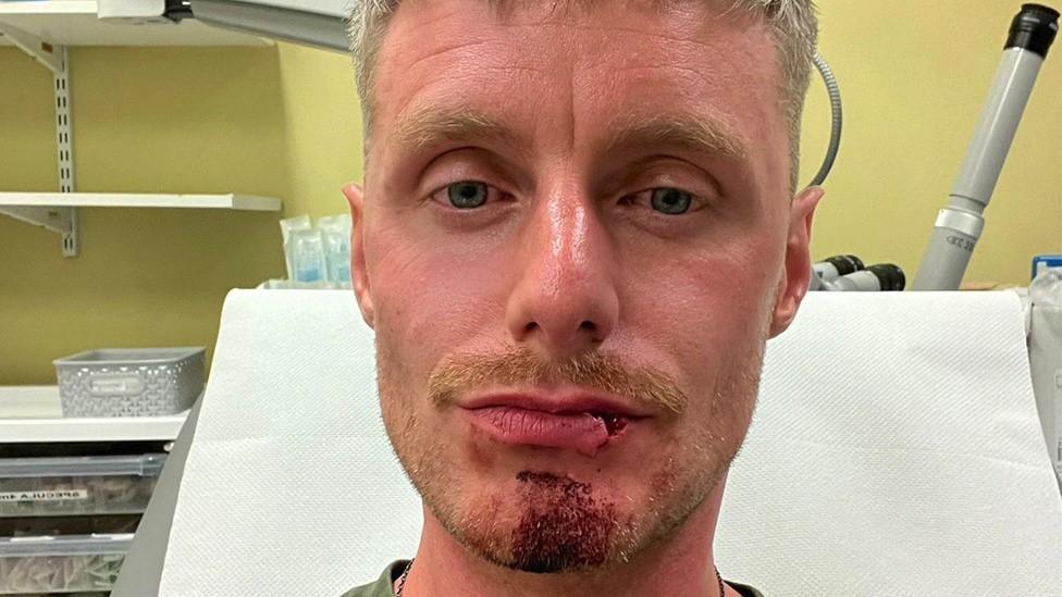 Man with cut lip sitting in a hospital bed