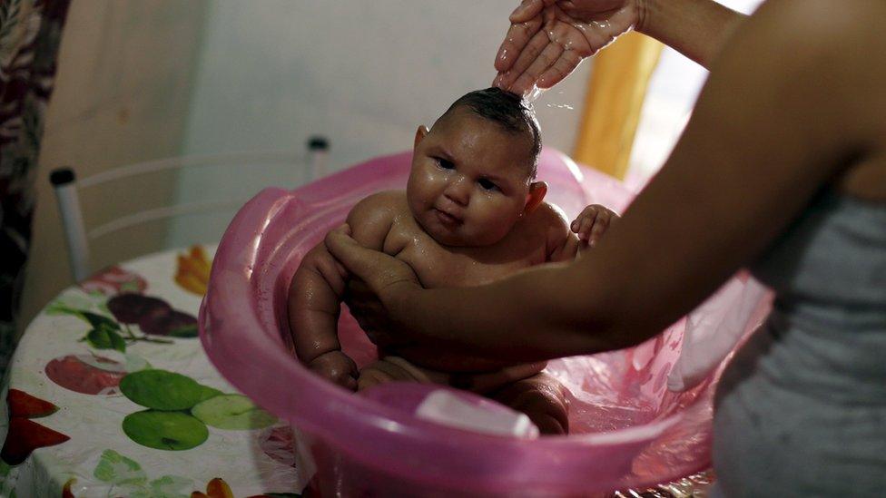 A baby who has microcephaly believed to be associated with the Zika virus