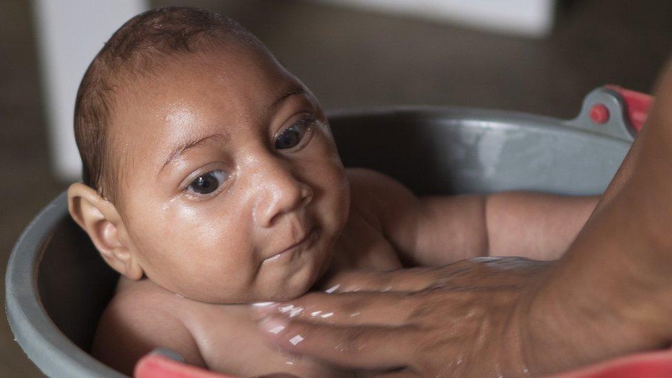 Baby with microcephaly