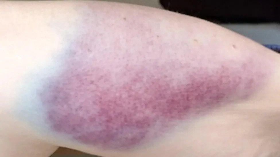 A large bruise