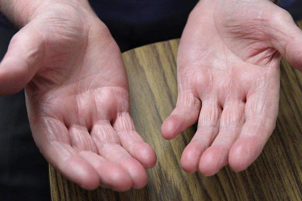 Hands of Redcar, Ernie