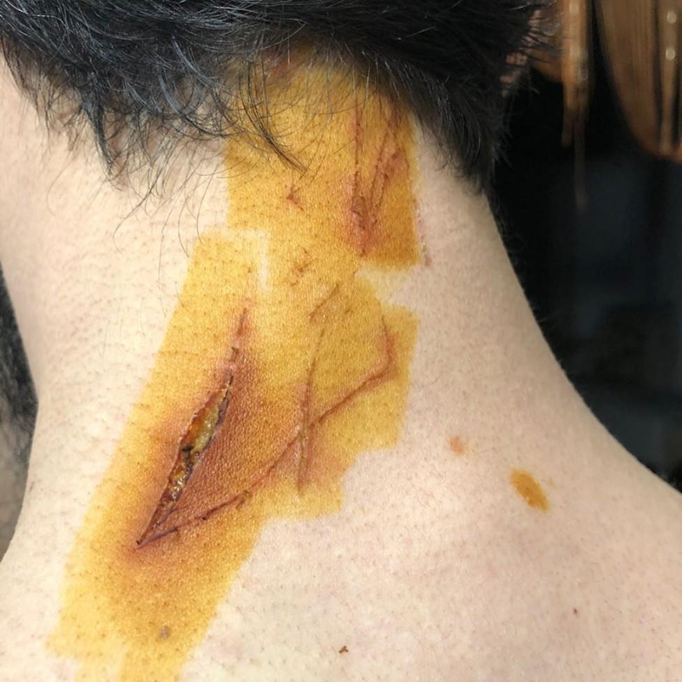 A gash in Tumso Abdurakhmanov's neck, caused by the claws of the hammer