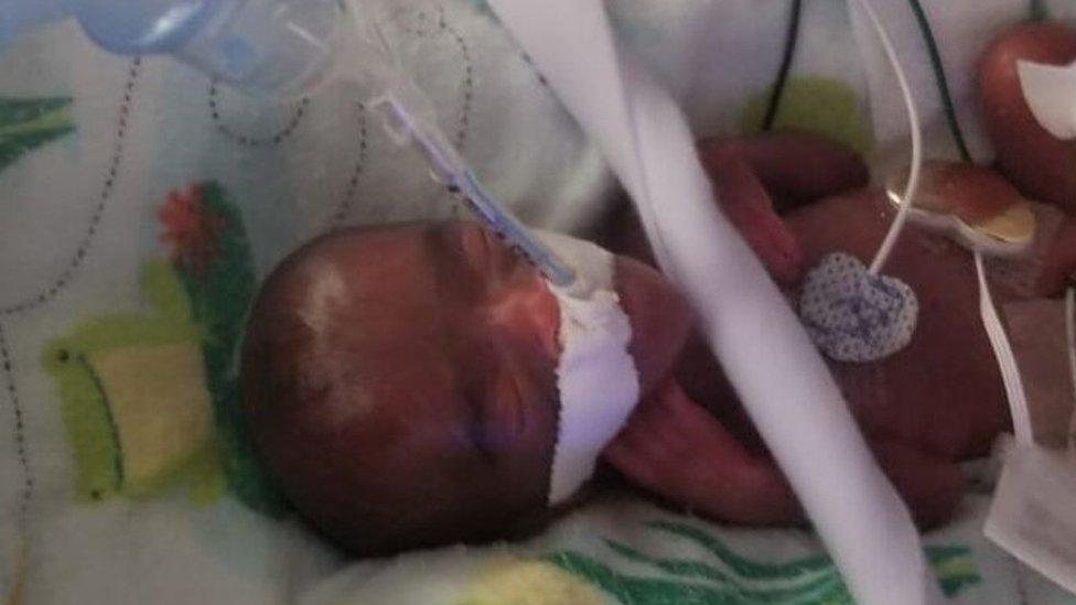 Premature baby in intensive care at Sharp Mary Birch Hospital