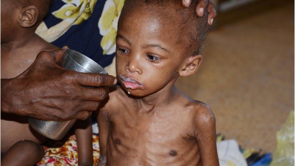 A starving boy is given water in Somalia