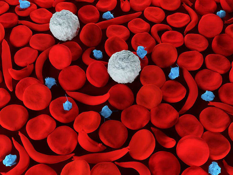 3d render of sickle cell anemia blood cells