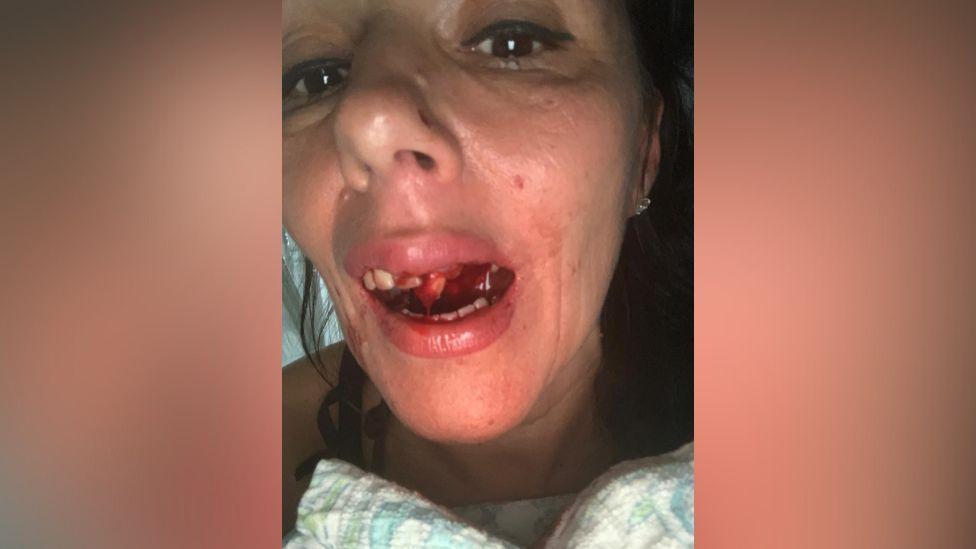 A photo of Eva Komuves who has her mouth open and her teeth are broken with blood dripping from them and her mouth. The photo is close up to her face. 