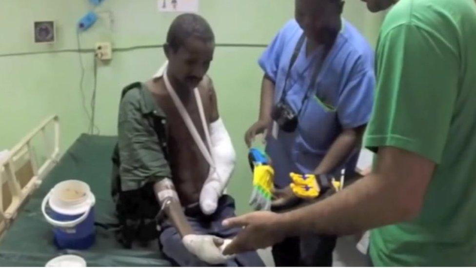 One of Team UnLimbited's hands is given to someone who lost their limb