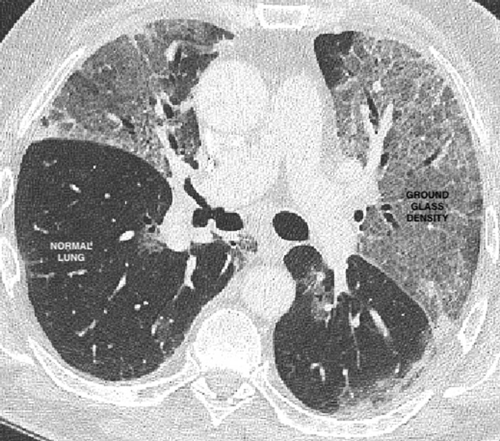 A lung scan showing Covid damage