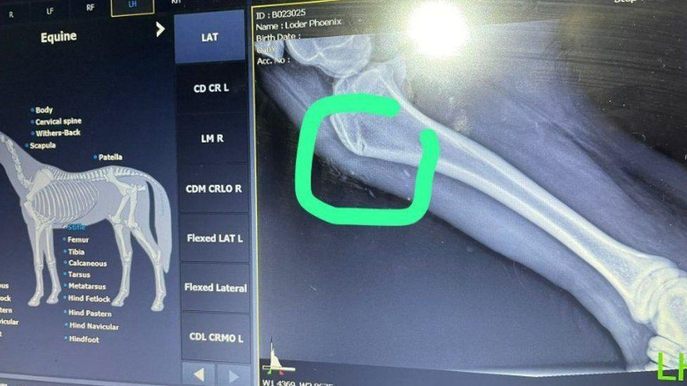 X-ray showing fracture in leg bone