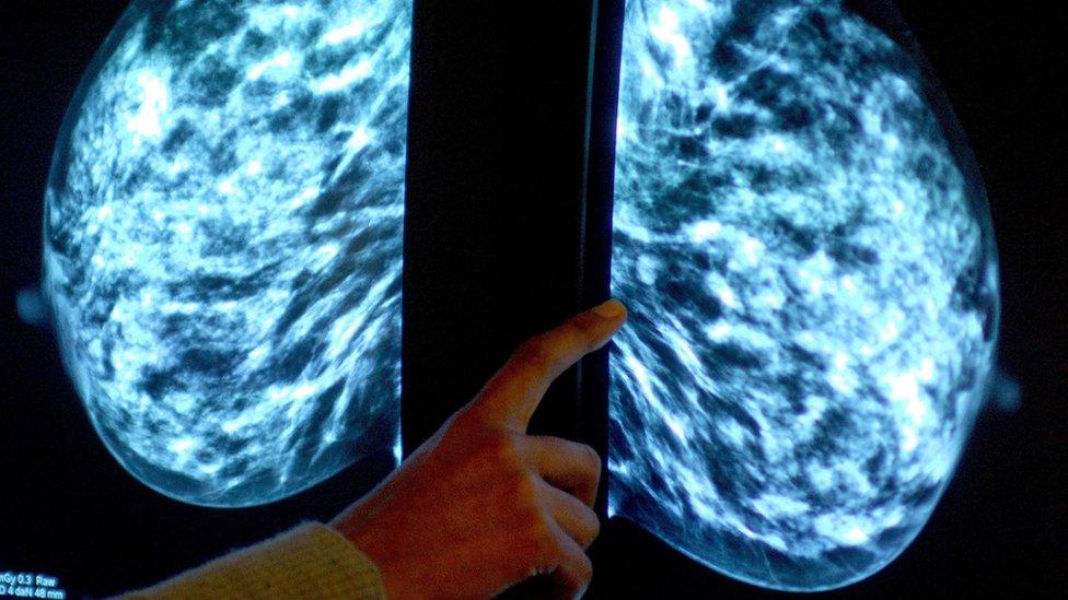 A mammogram showing female breasts in order check for breast cancer