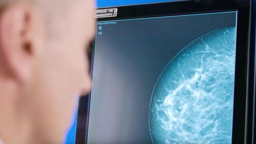 Breast screening