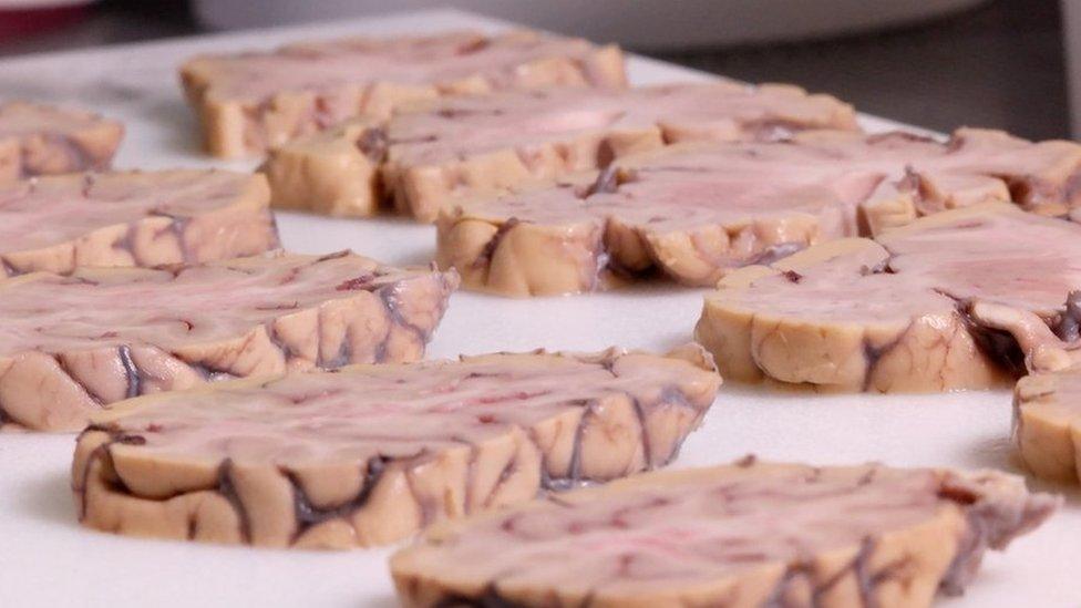 Slices of human brain