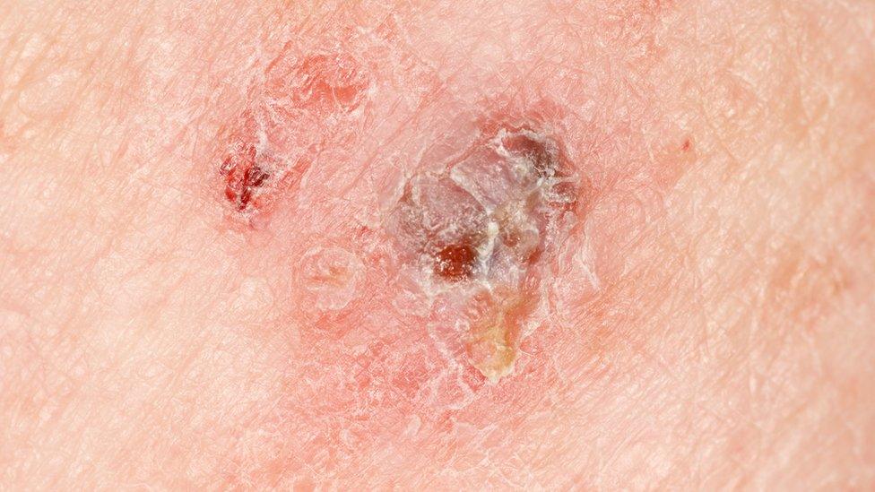 Melanoma