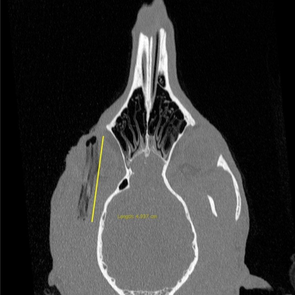 CT scan of skull showing stick