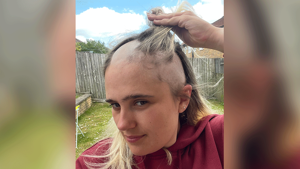 Phoebe showing her hair loss whilst stood in a garden.