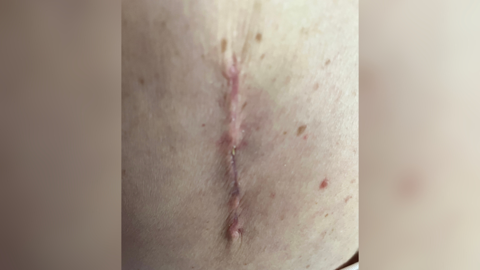 Natasha's scar after surgery