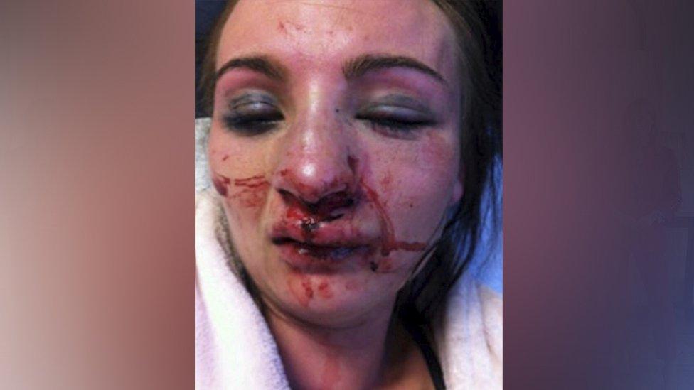 Rebecca Beattie with bruises and blood on her face