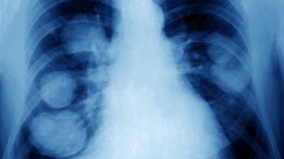 Lung cancer