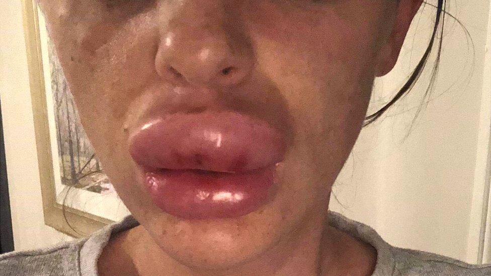 Rachael Knappier had lip filler