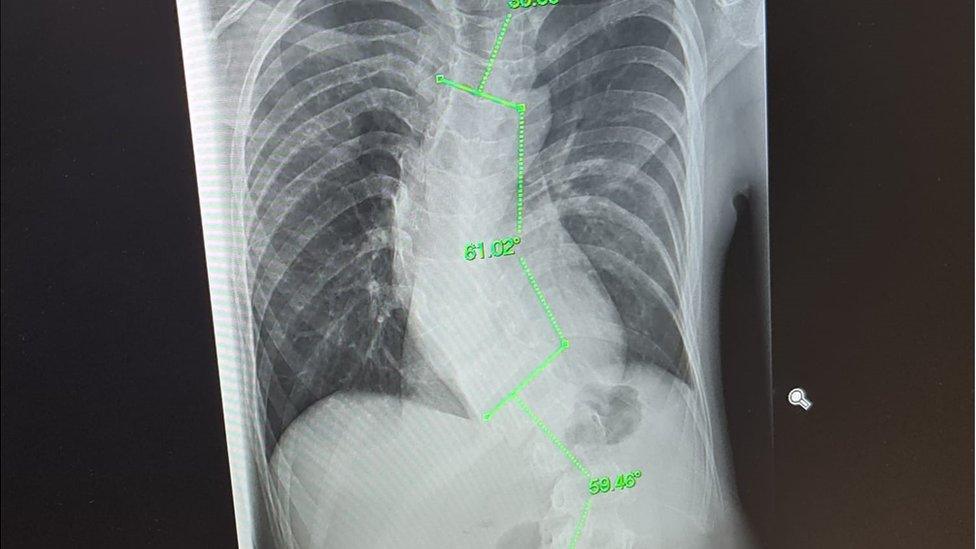 X-rays show George Pike's spine curvature