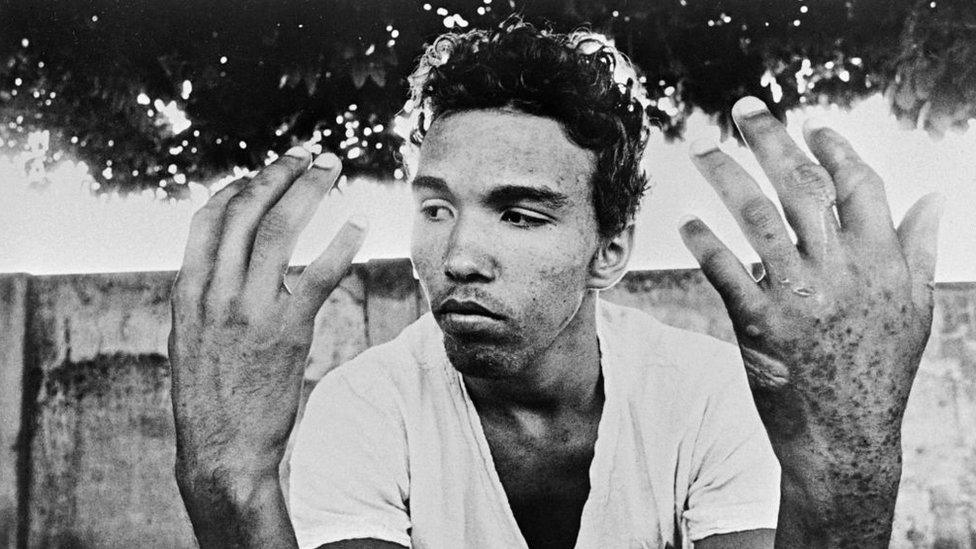 A man with severe burns to his hands from encountering radioactive material in Brazil, 1987