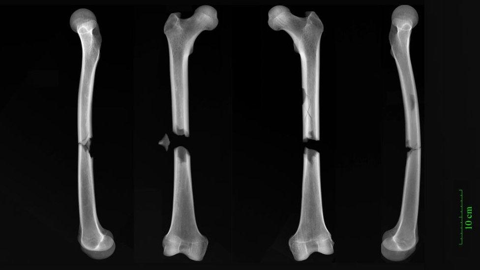 Fractures shown in X-ray