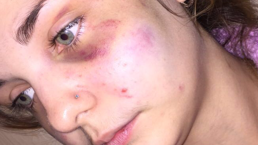 Zoe Castle pictured with a bruised face and black eye