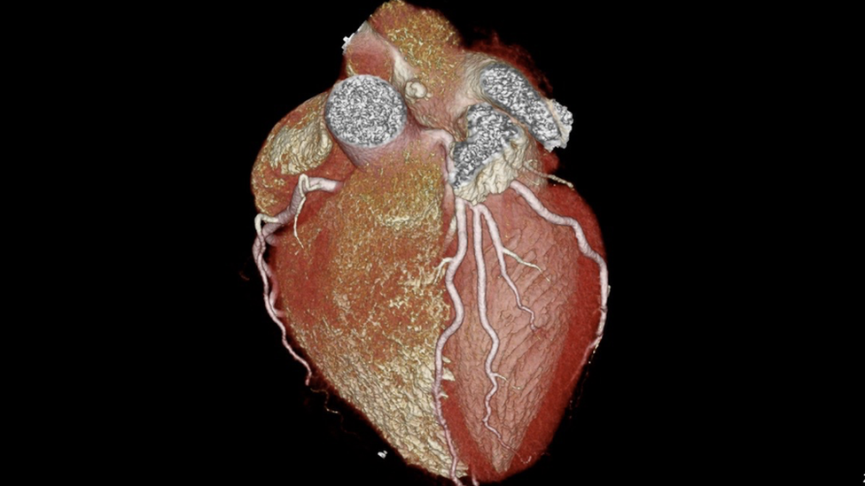 Scan of a heart