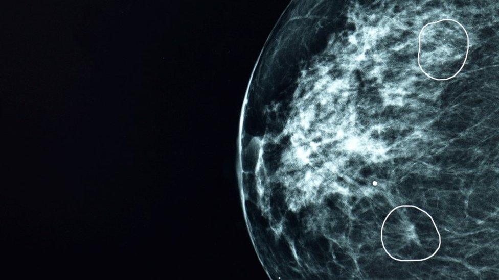 AI tool Mia circles two areas of concern on a mammogram scan