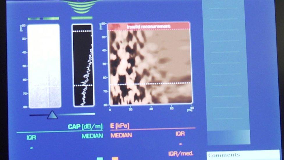 Liver scan display