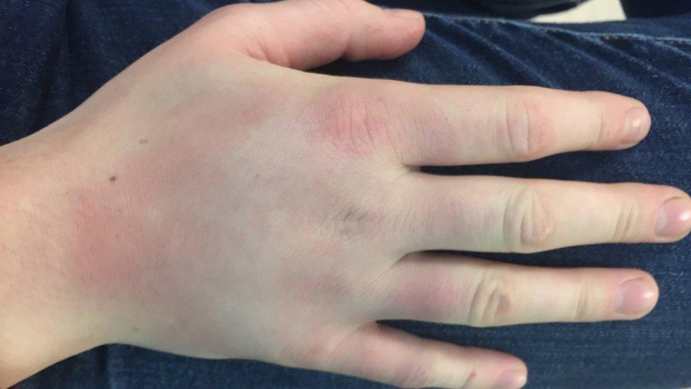 Alice Franklin's bruised hand