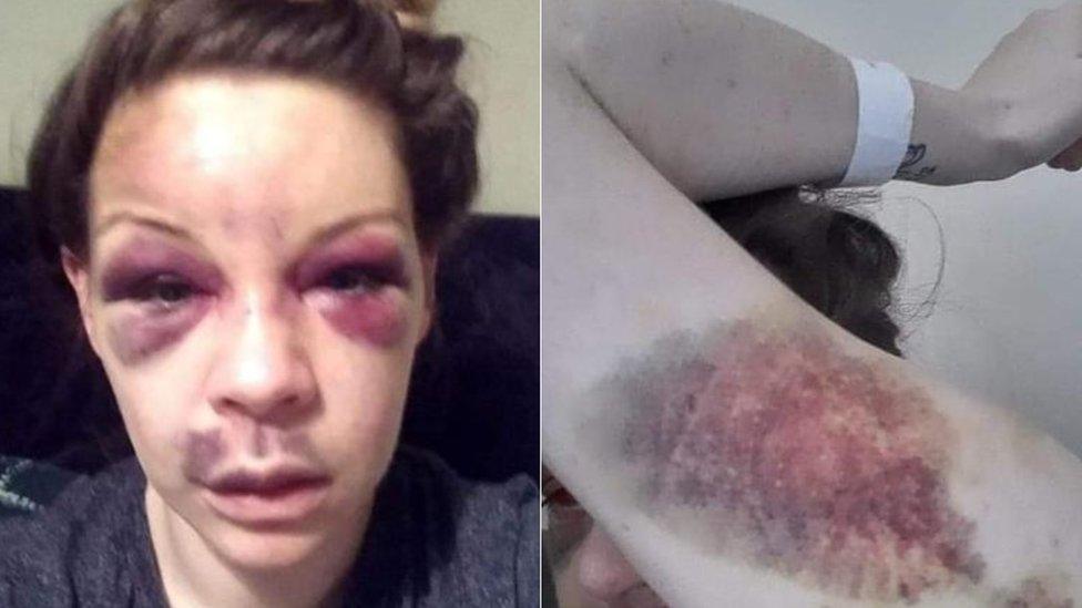 Pictures showing bruising to Louise Gilmore's face and arm