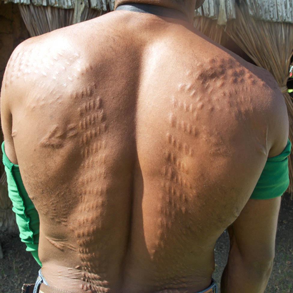 Man in Womburn with back scarred to resemble a crocodile's hide