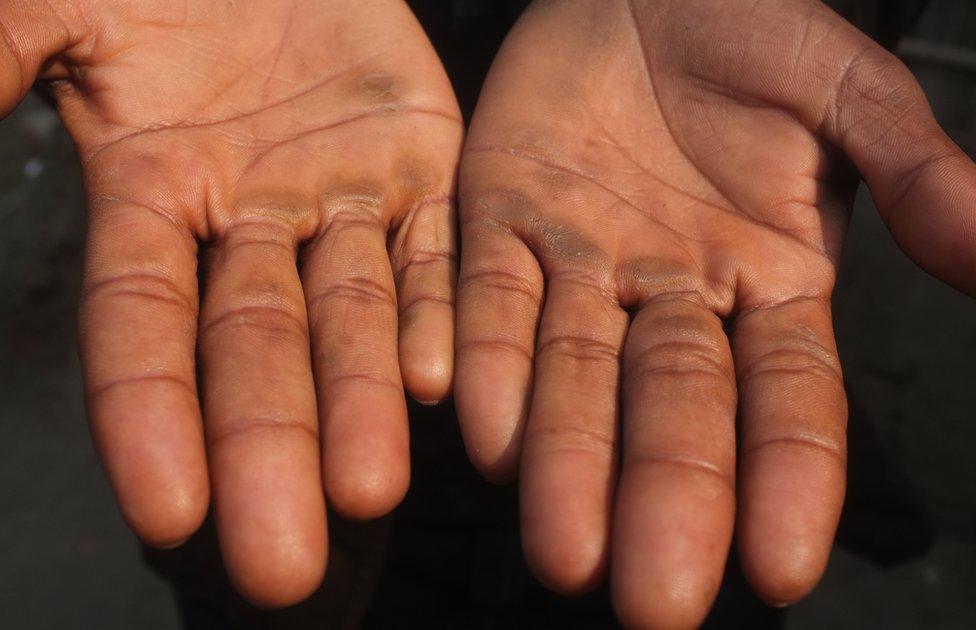 Abdul Alim shows his calloused palms