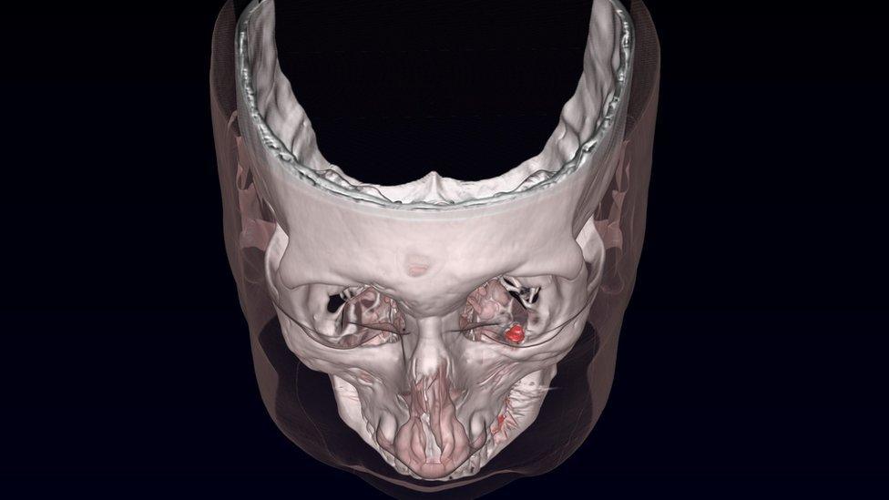 A false colour rendered CT scan after the first implantation in one eye