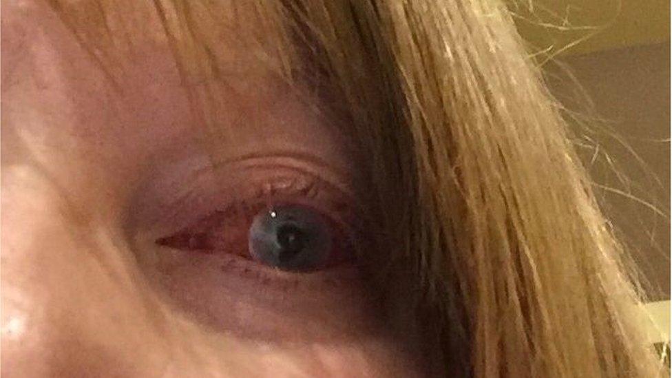 Marie Mason's eye became badly infected