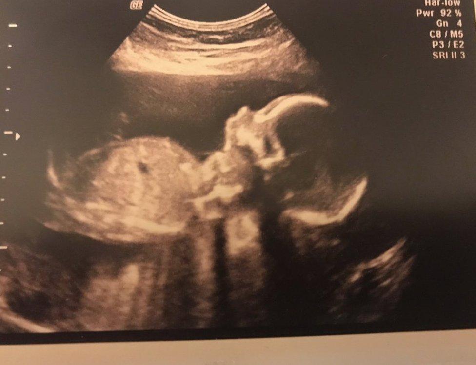 Scan of Laura's baby