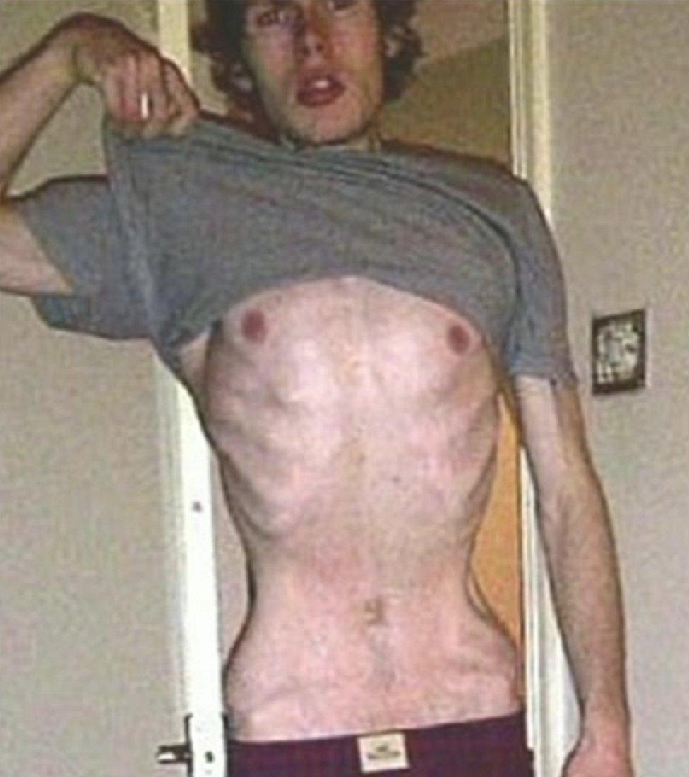 Steven Brazier looking very thin